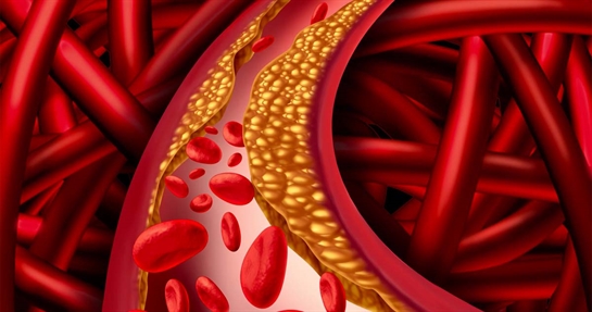 Dislipidemia, cause, dieta ed integrazione Dislipidemia, cause, dieta ed integrazione