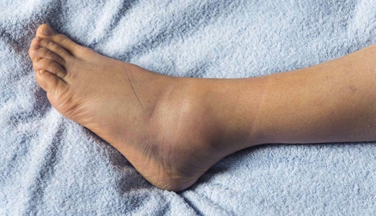 Edema gambe cause cure