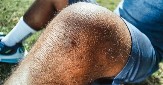 Iperuricemia, o eccesso di acidi urici, cause e rimedi alimentari Iperuricemia, o eccesso di acidi urici, cause e rimedi alimentari