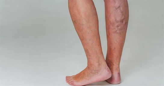 Stasi venosa alle gambe Stasi venosa alle gambe